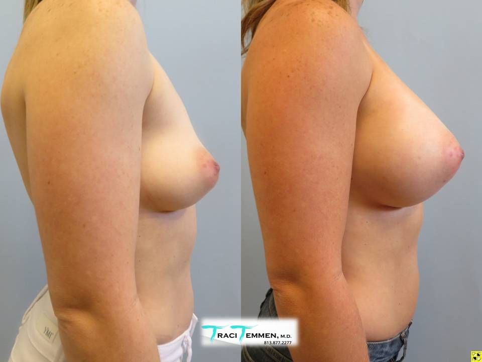 Breast Augmentation Before & After