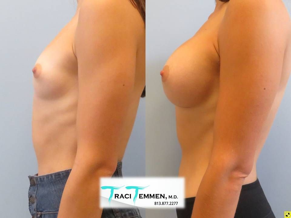 Breast Augmentation Before & After