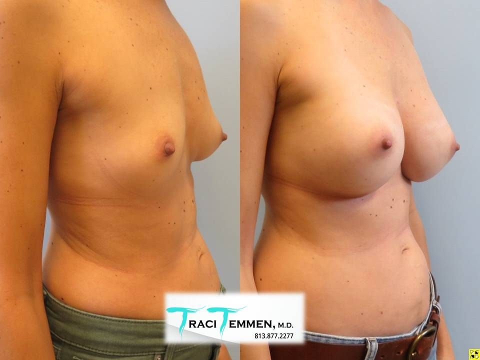Breast Augmentation Before & After