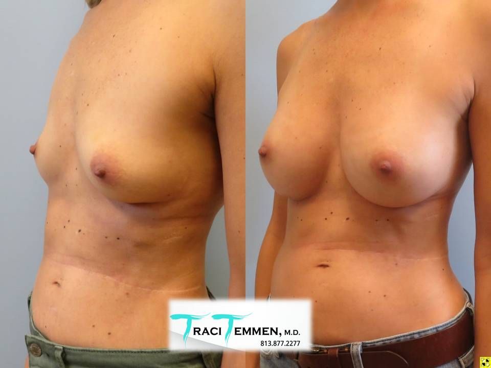 Breast Augmentation Before & After