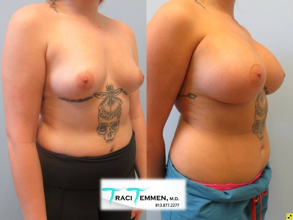 Breast Augmentation Before & After