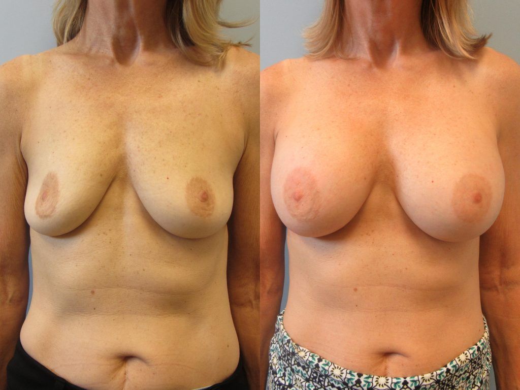 Breast Augmentation Before & After