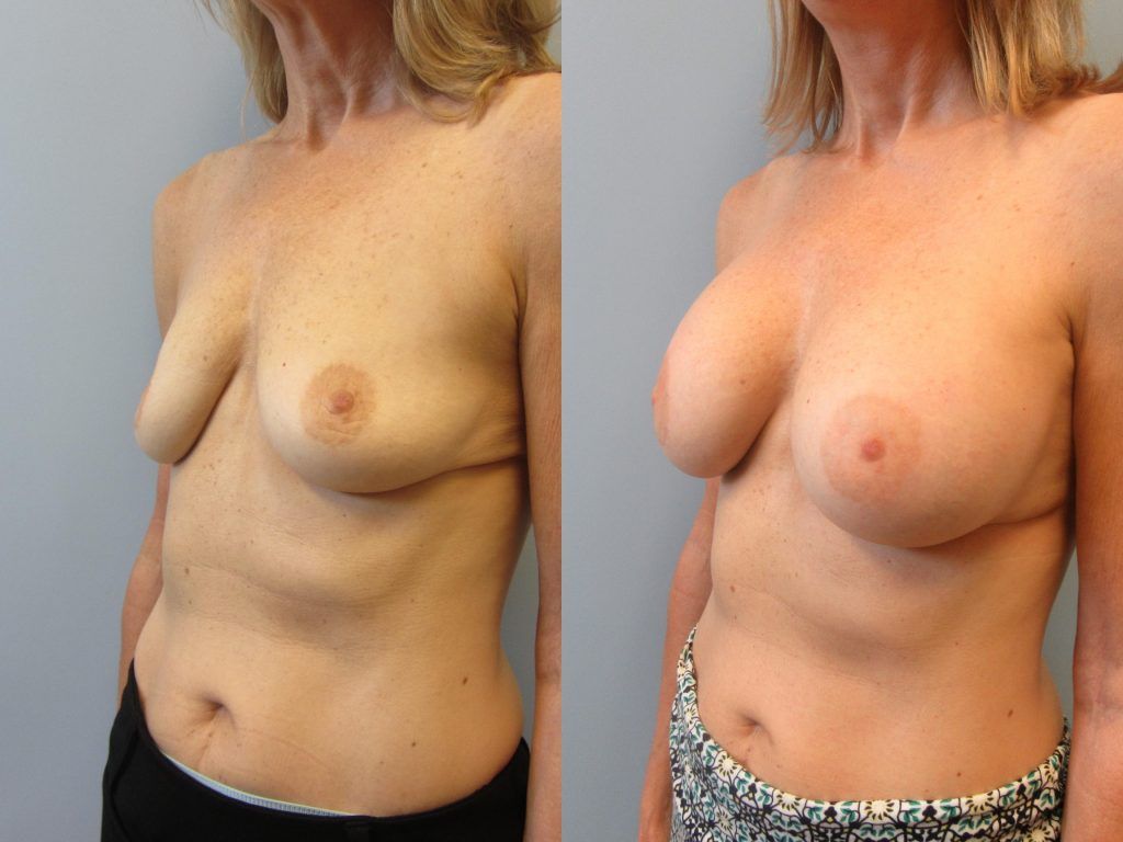 Breast Augmentation Before & After