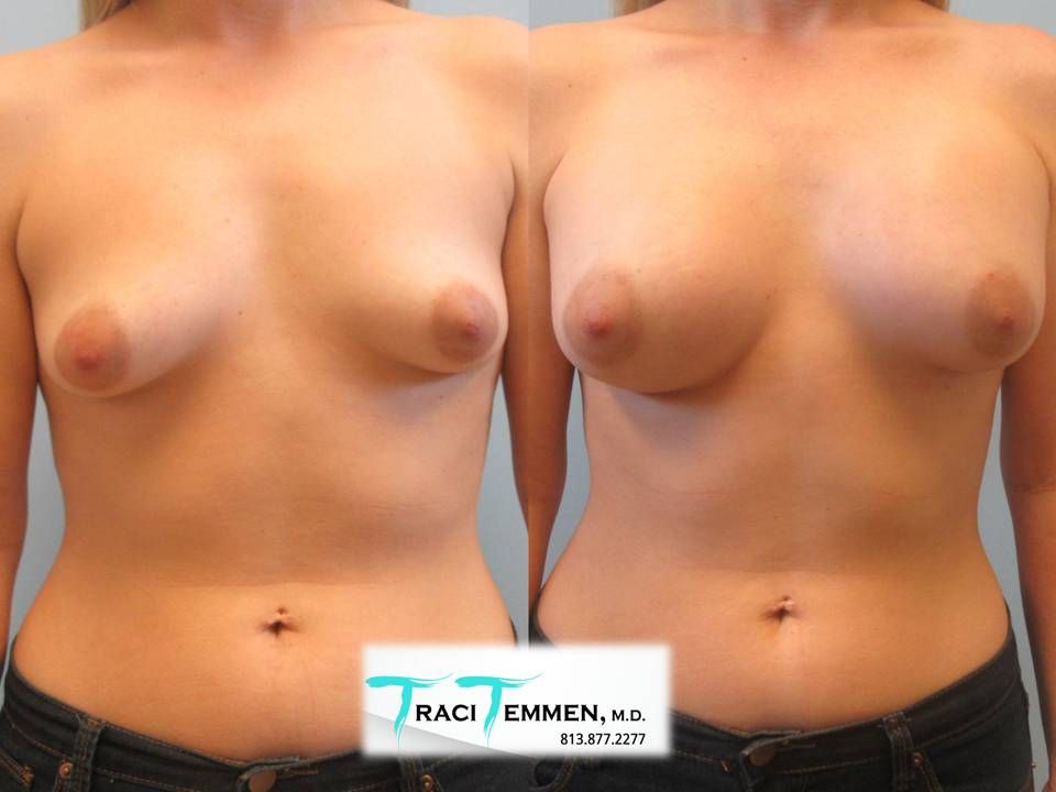 Breast Augmentation Before & After