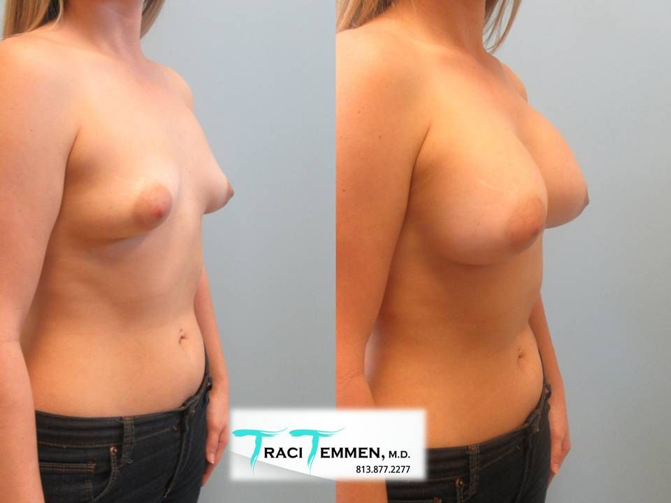 Breast Augmentation Before & After
