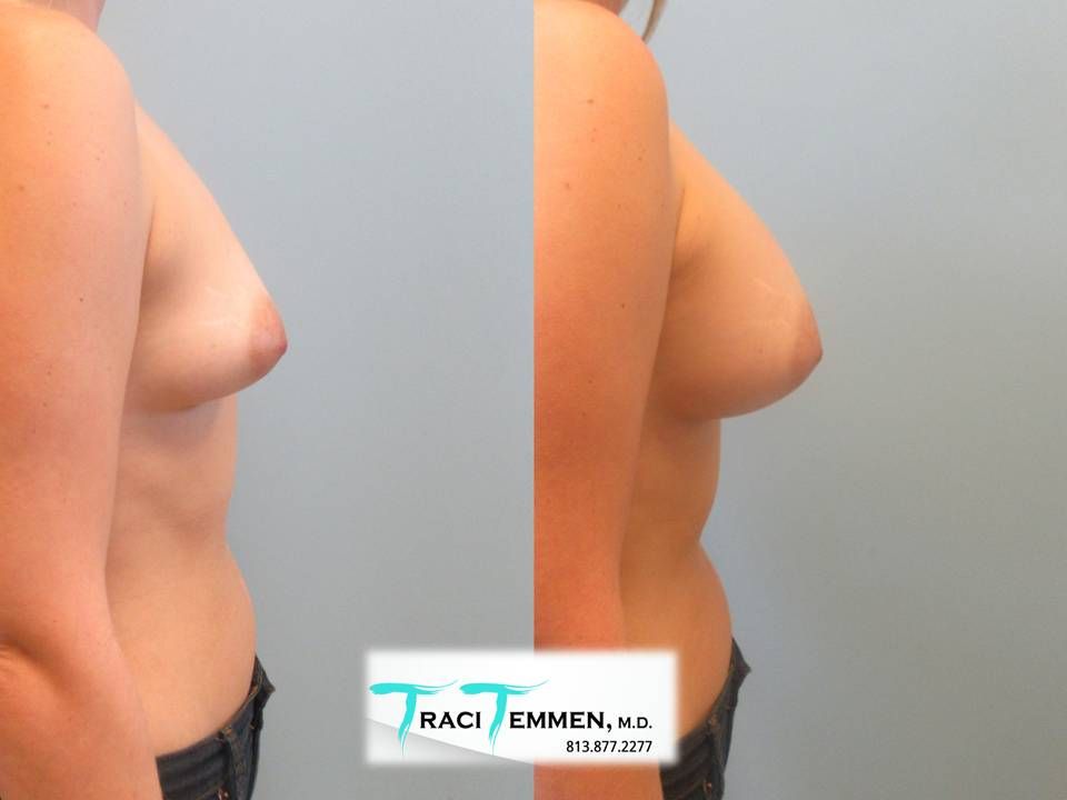 Breast Augmentation Before & After