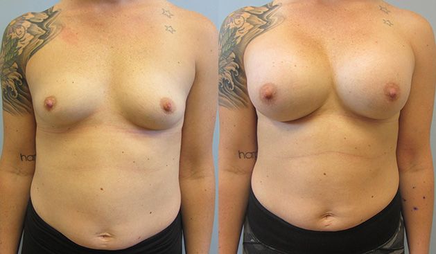 Breast Augmentation Before & After