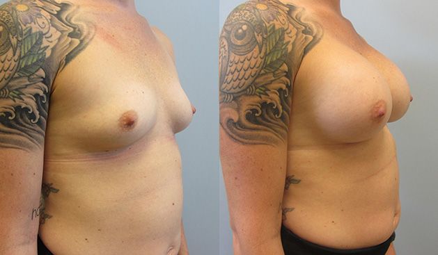 Breast Augmentation Before & After
