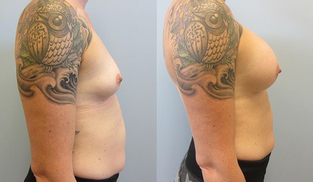 Breast Augmentation Before & After