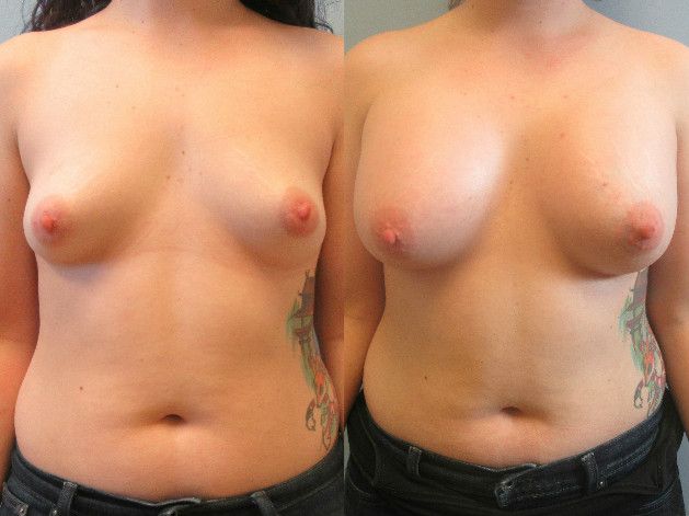 Breast Augmentation Before & After