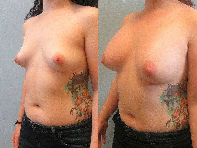 Breast Augmentation Before & After