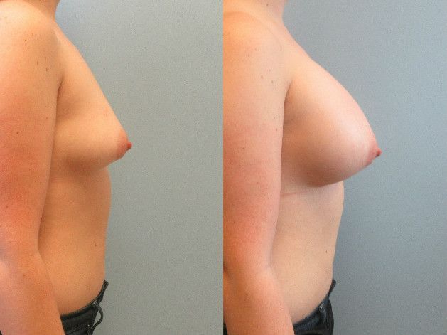 Breast Augmentation Before & After