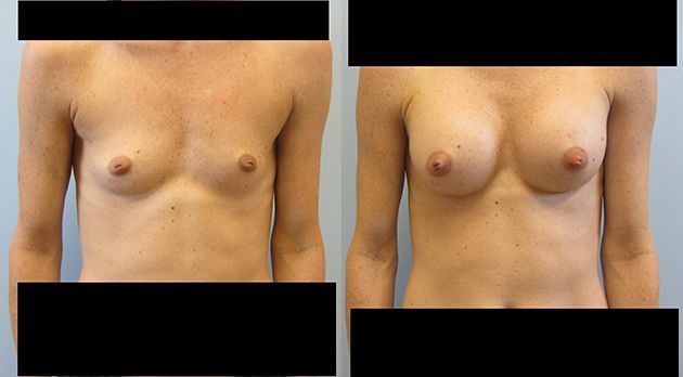 Breast Augmentation Before & After