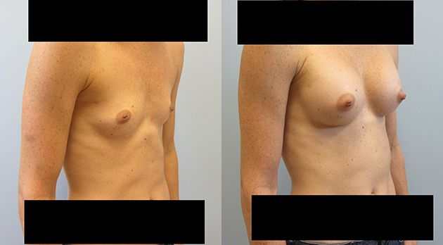 Breast Augmentation Before & After