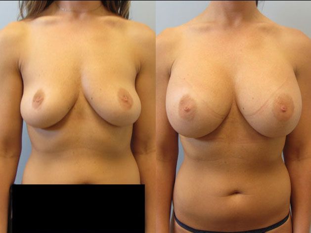 Breast Augmentation Before & After