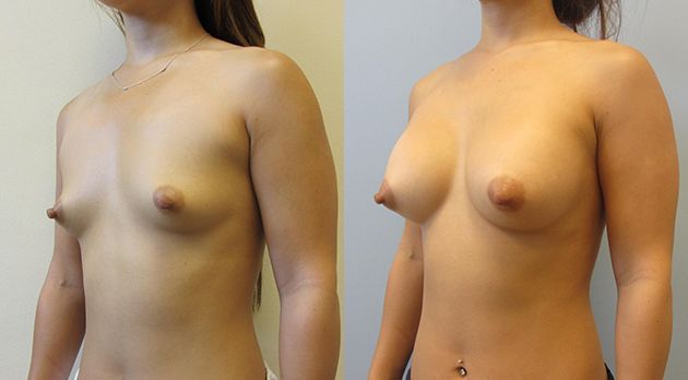 Breast Augmentation Before & After