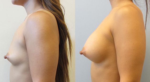 Breast Augmentation Before & After