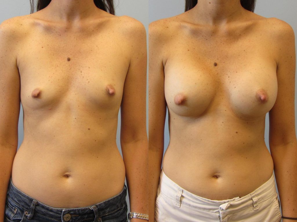 Breast Augmentation Before & After