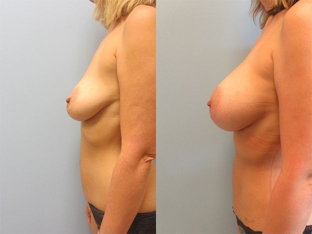 Breast Augmentation Before & After