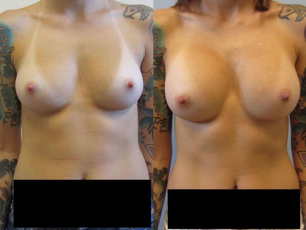 Breast Augmentation Before & After