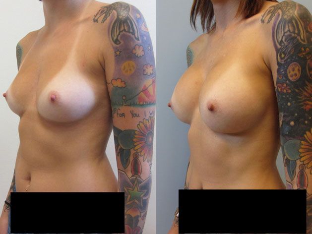 Breast Augmentation Before & After