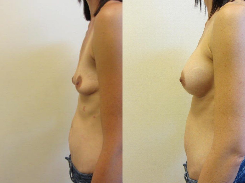 Breast Augmentation Before & After