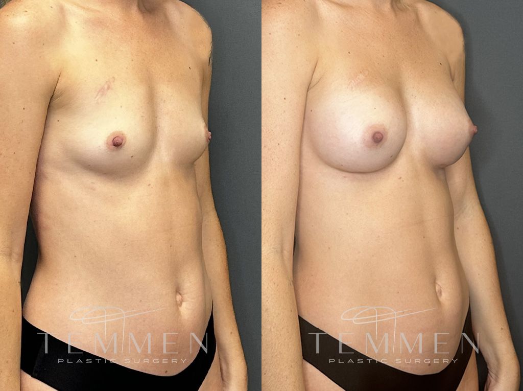 Breast Augmentation Before & After