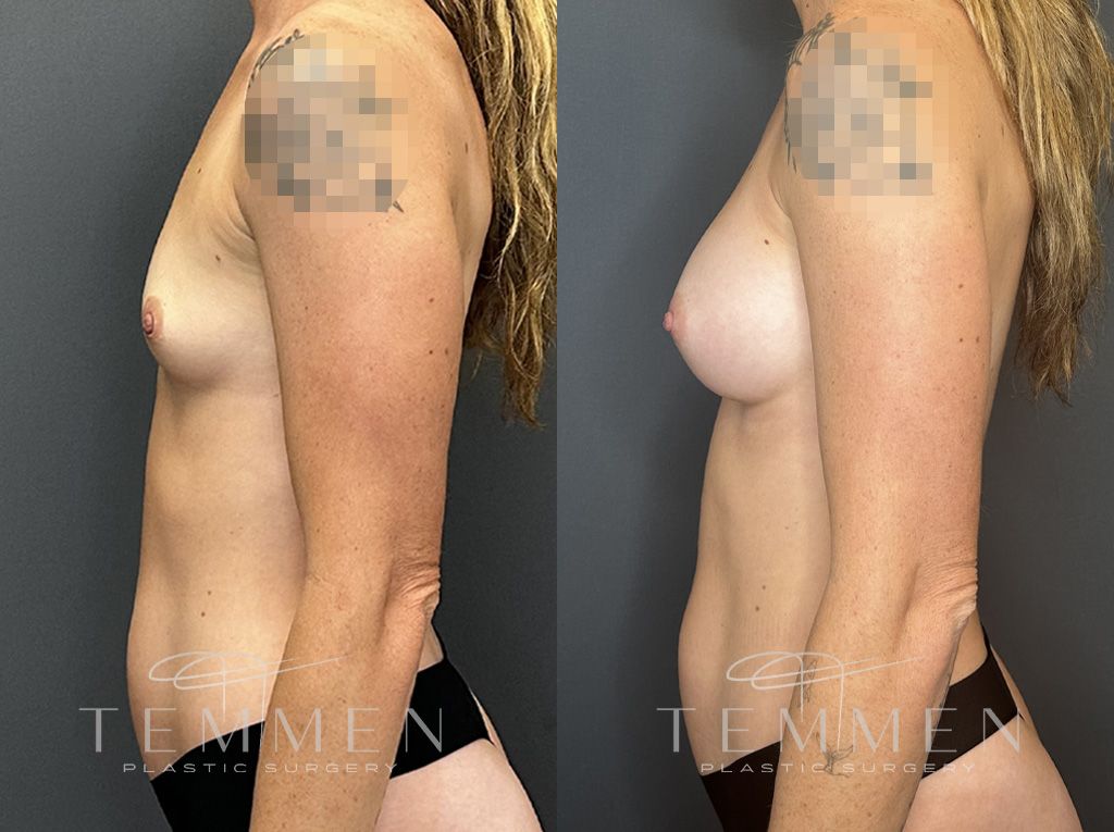 Breast Augmentation Before & After