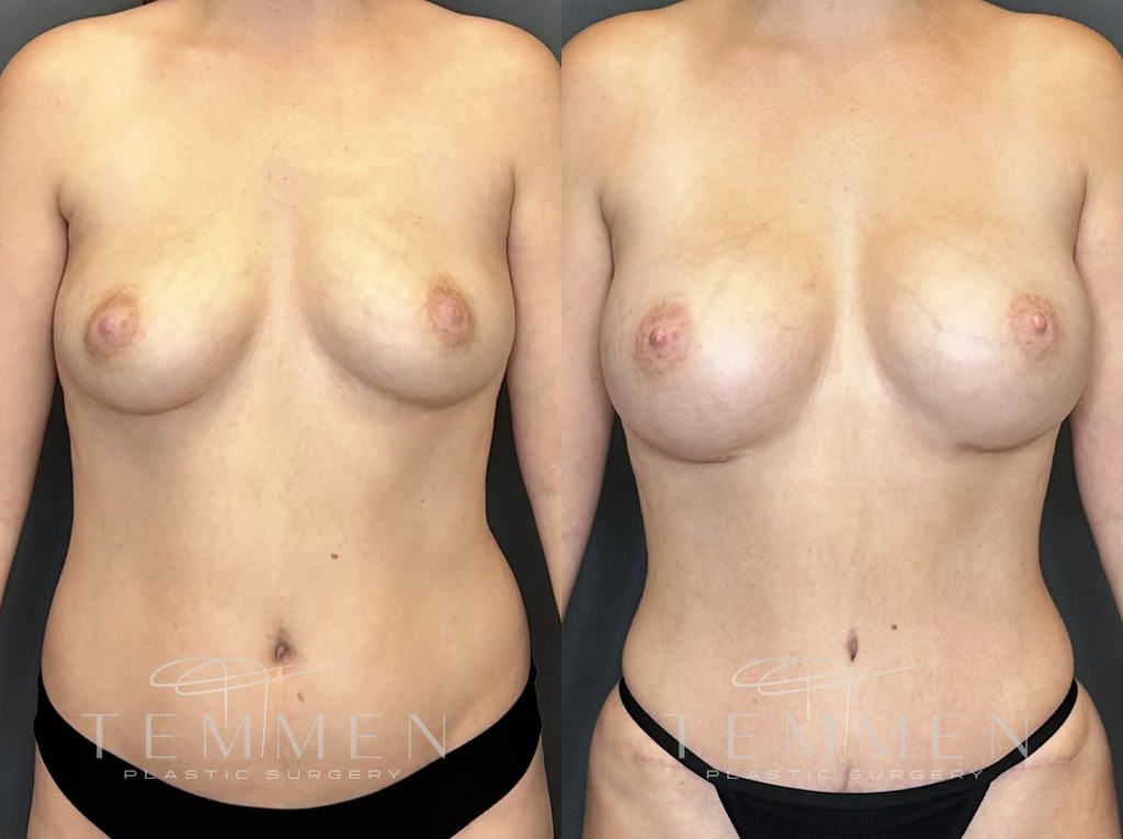 Breast Augmentation Before & After