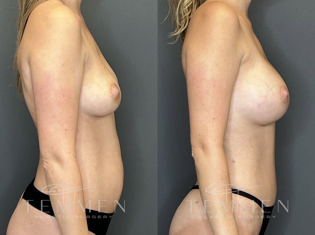 Breast Augmentation Before & After
