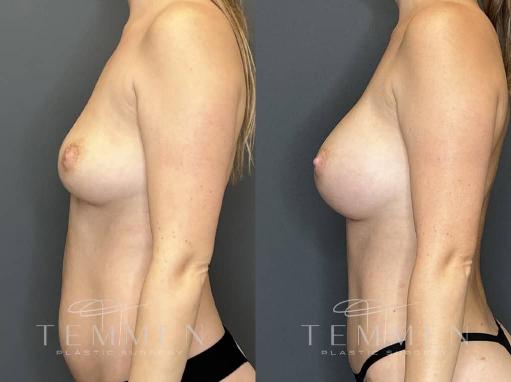 Breast Augmentation Before & After