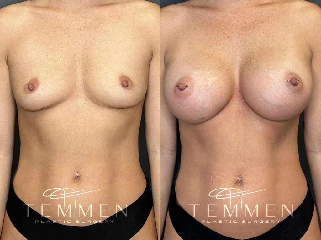 Breast Augmentation Before & After