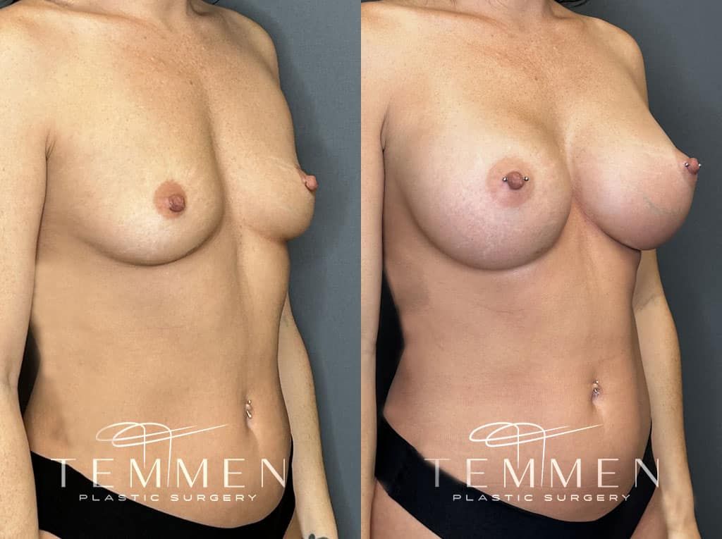 Breast Augmentation Before & After