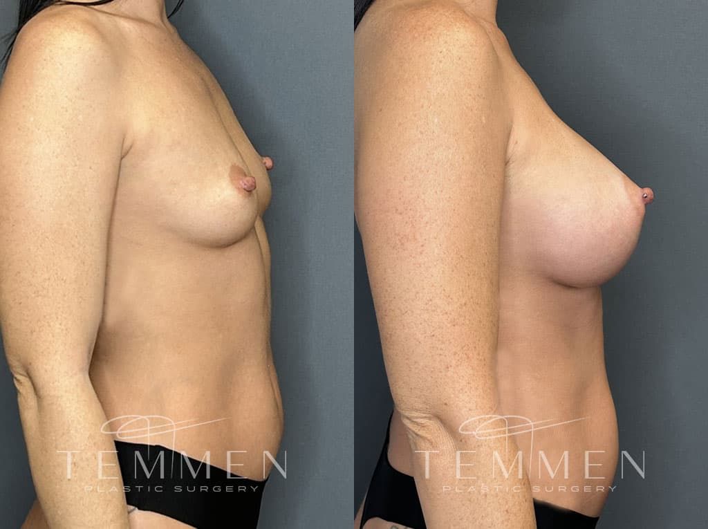 Breast Augmentation Before & After
