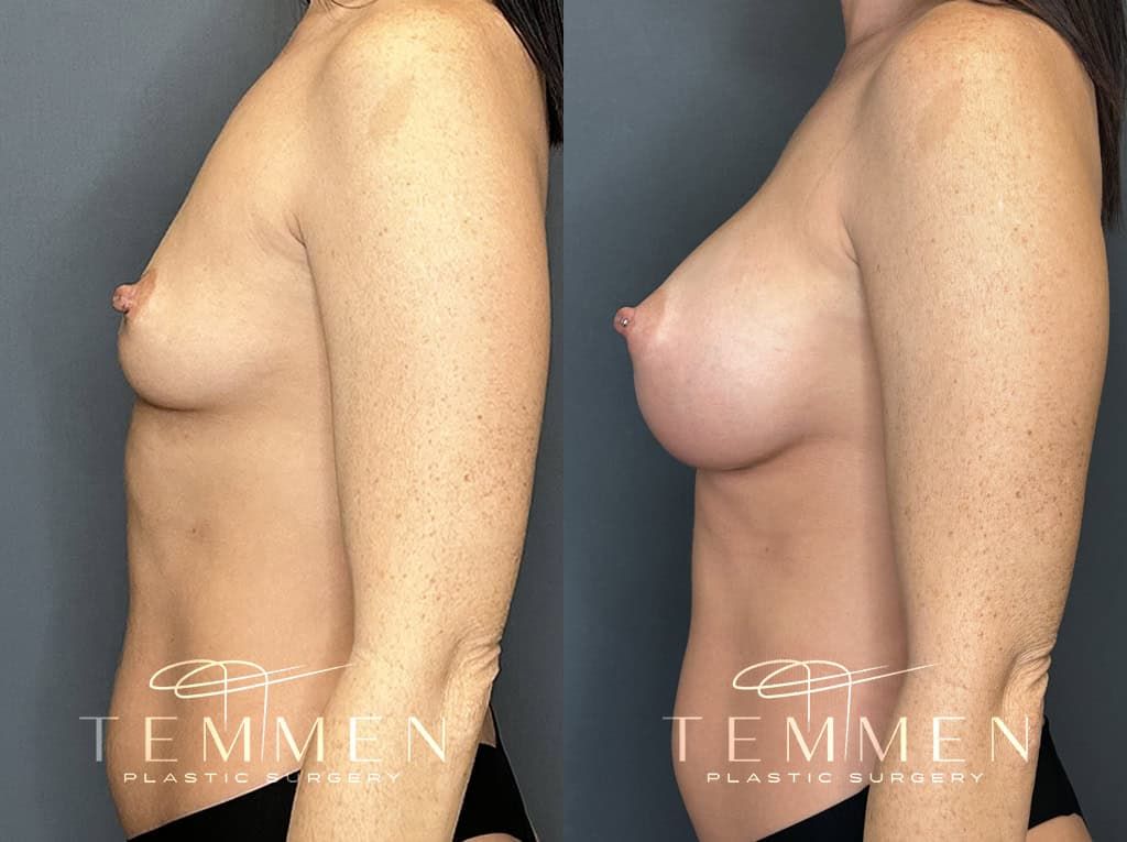Breast Augmentation Before & After