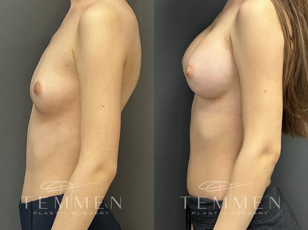 Breast Augmentation Before & After