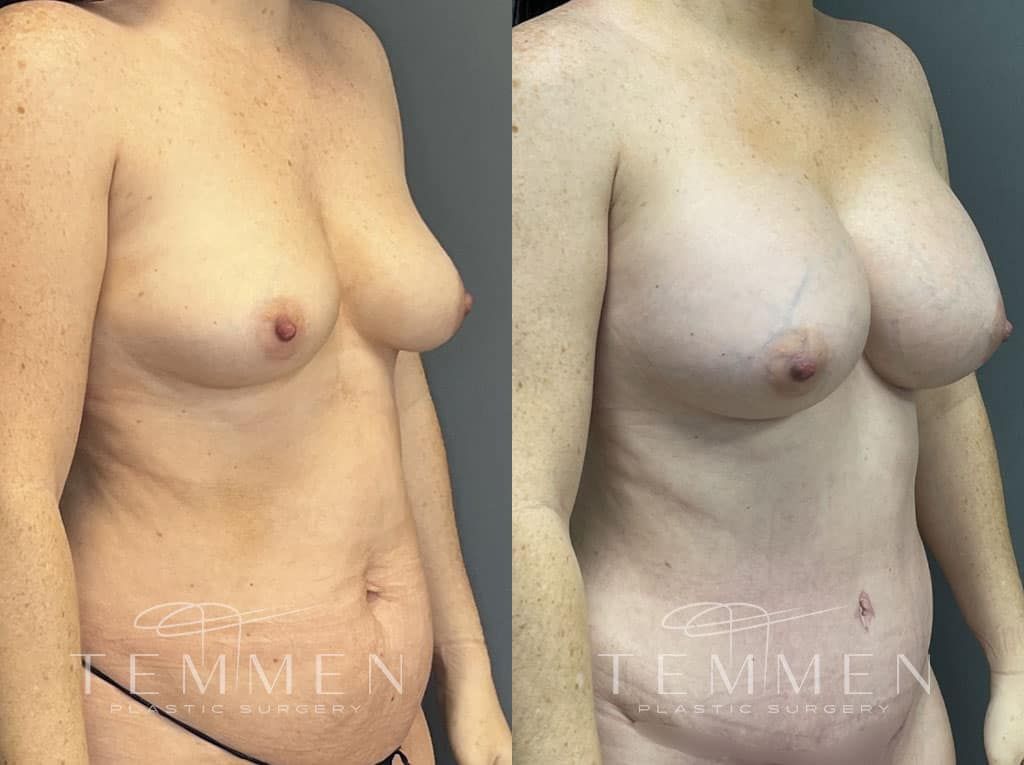 Breast Augmentation Before & After