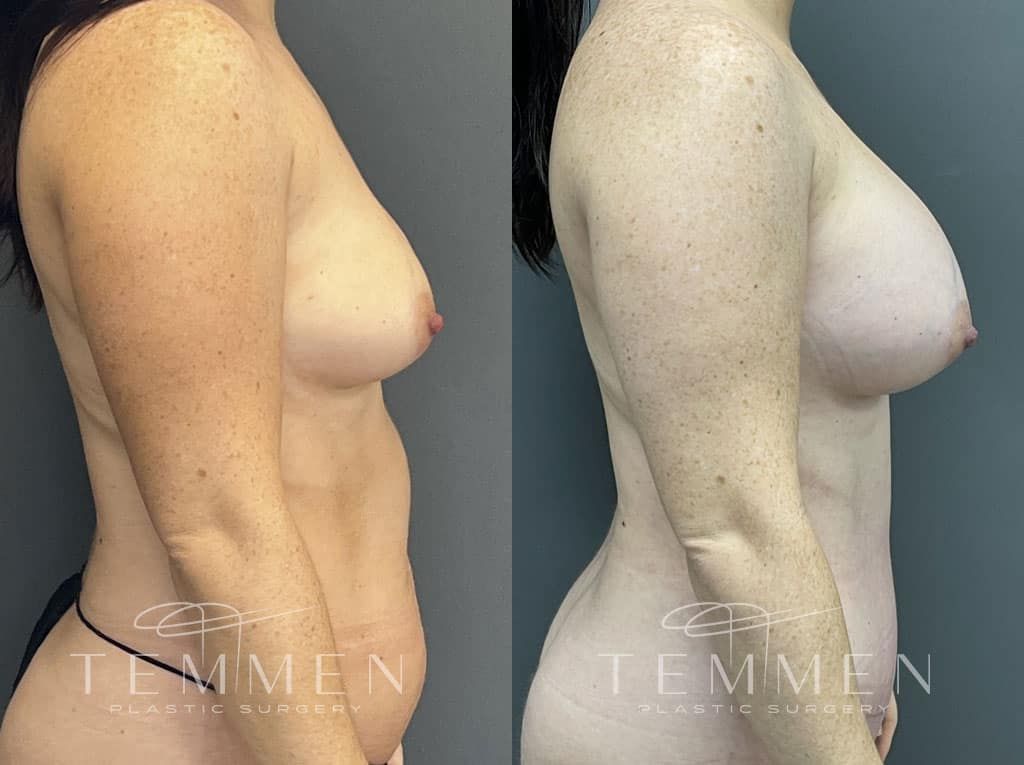 Breast Augmentation Before & After