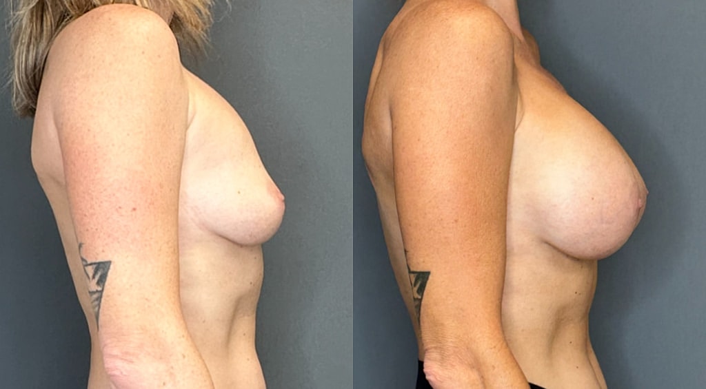 Breast Augmentation Before & After