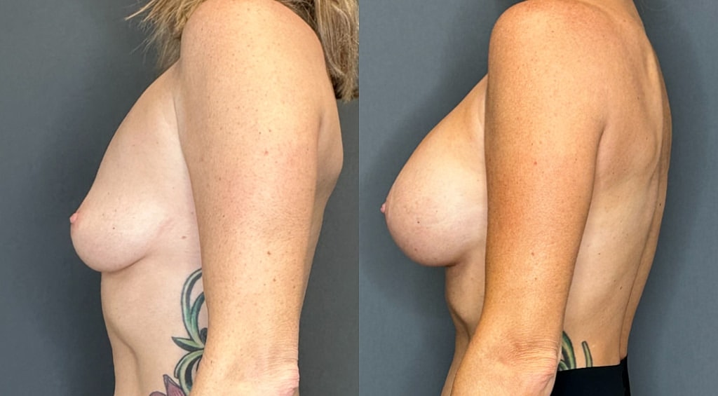 Breast Augmentation Before & After