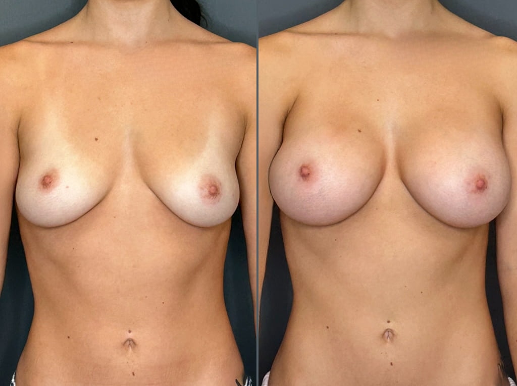 Breast Augmentation Before & After