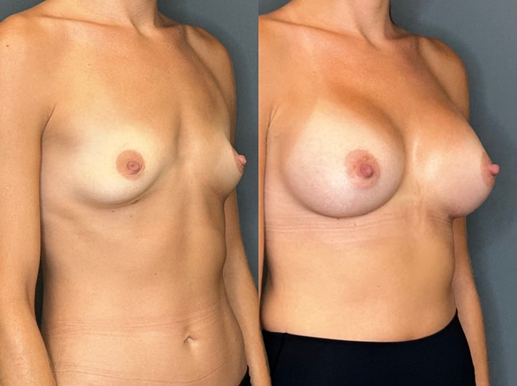 Breast Augmentation Before & After