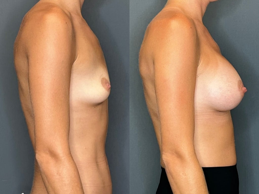 Breast Augmentation Before & After