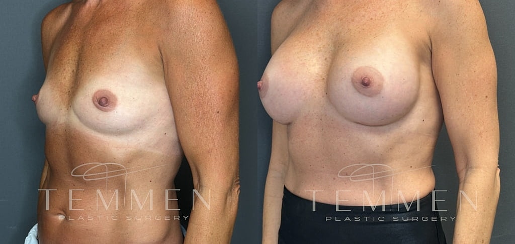 Breast Augmentation Before & After