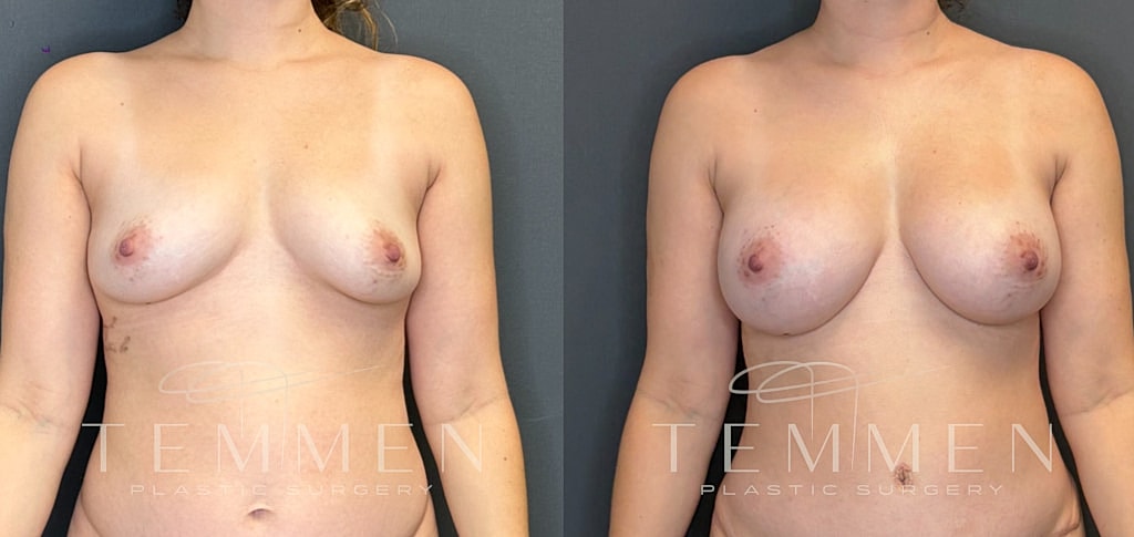 Breast Augmentation Before & After