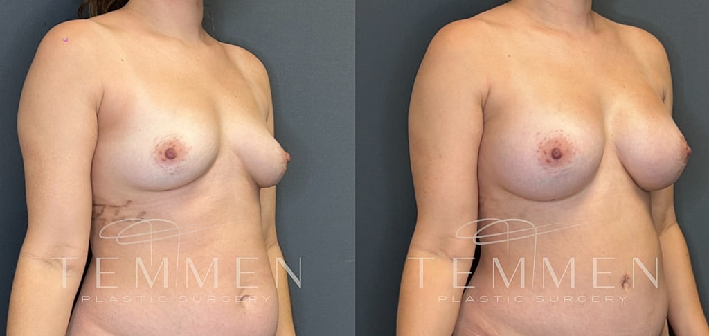 Breast Augmentation Before & After