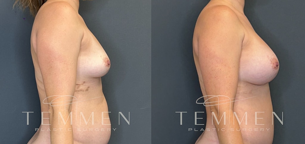 Breast Augmentation Before & After
