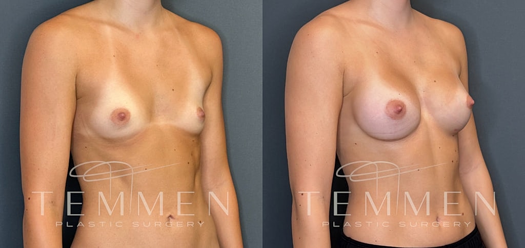 Breast Augmentation Before & After