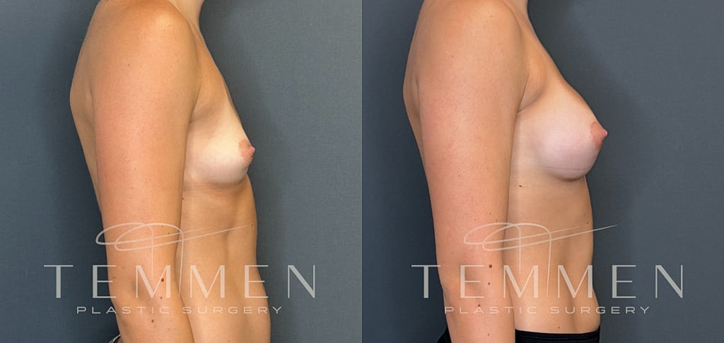 Breast Augmentation Before & After