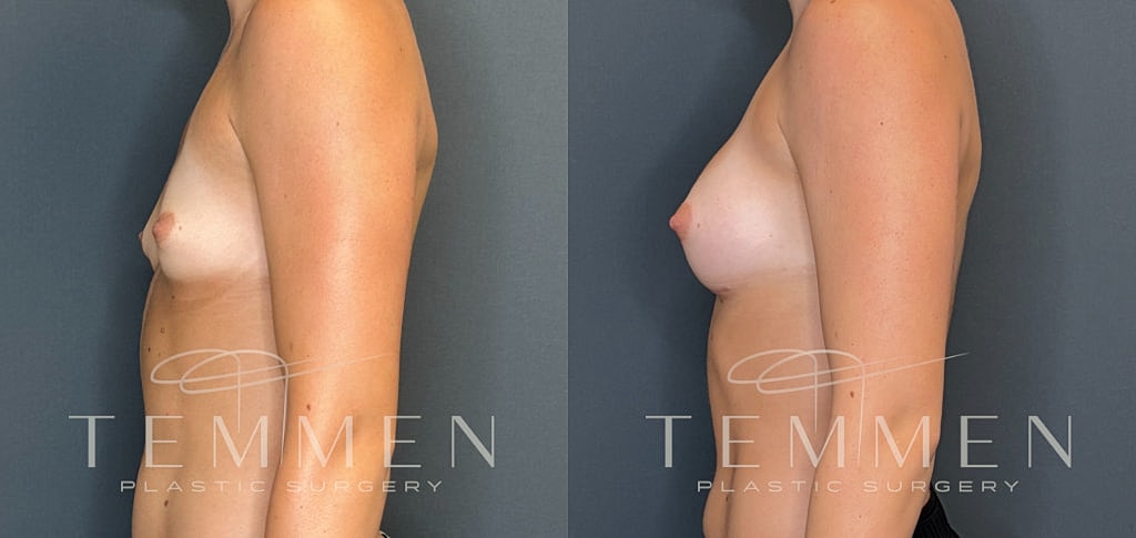 Breast Augmentation Before & After